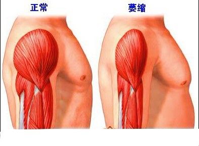 肌肉萎縮難返學 教院生上門義教